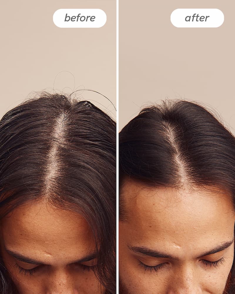 Instant Relief™ Dandruff Shampoo - Image 4